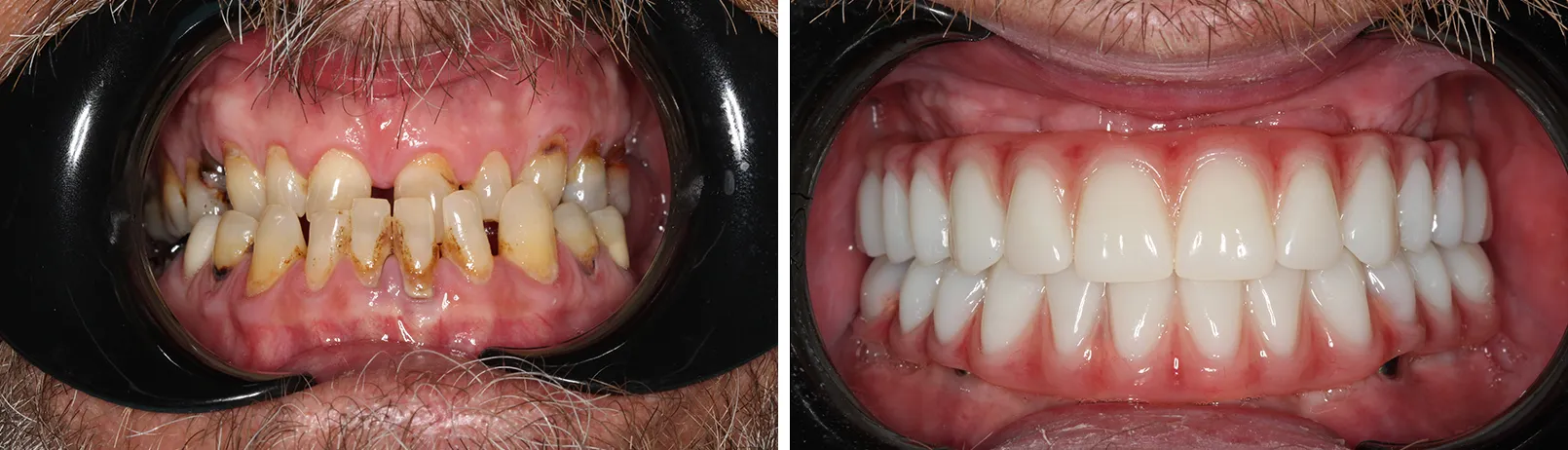 Patient smile before and after dental implant treatment