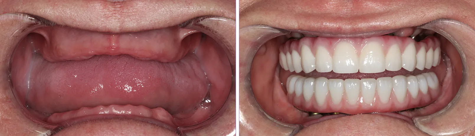 Patient smile before and after dental implant treatment