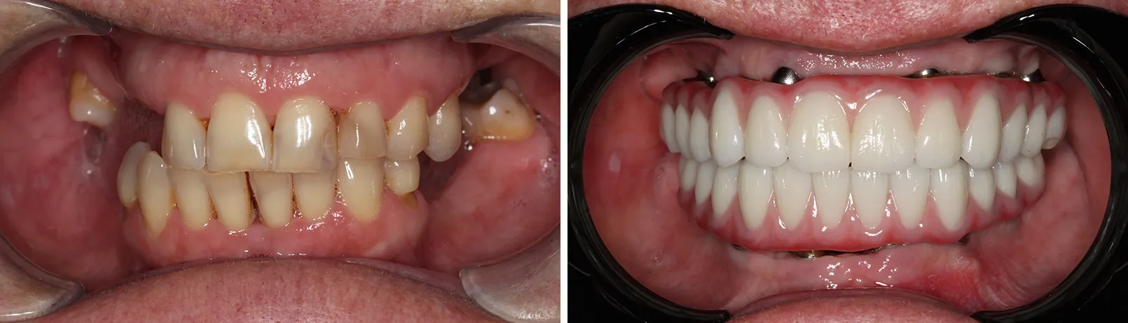 Patient smile before and after dental implant treatment