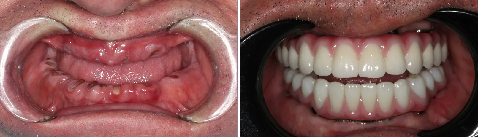 Patient smile before and after dental implant treatment
