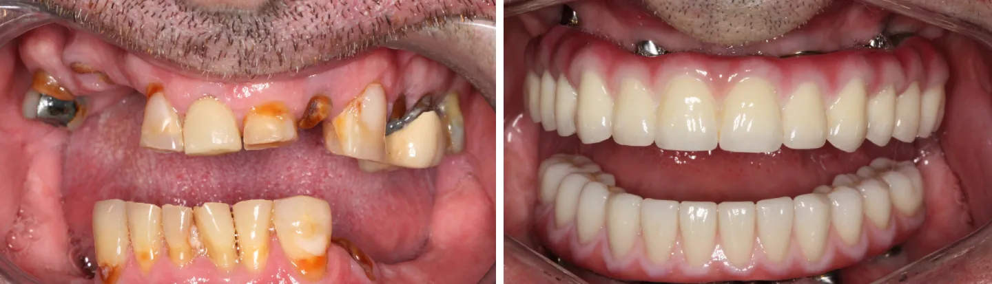 Patient smile before and after dental implant treatment