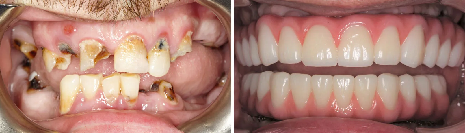 Patient smile before and after dental implant treatment