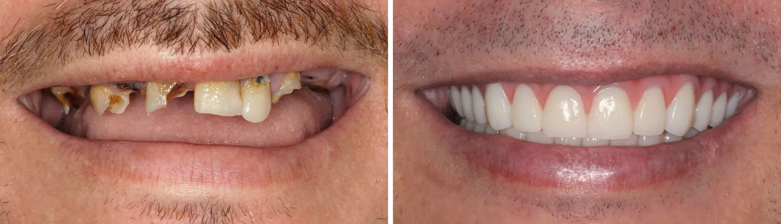 Patient smile before and after dental implant treatment