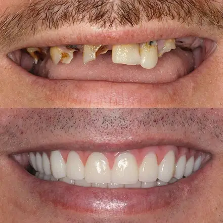 Before and after dental implant treatment — missing and damaged teeth replaced with a full, natural-looking smile.